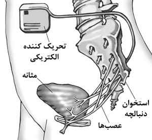 تحریک الکتریکی بی اختیاری