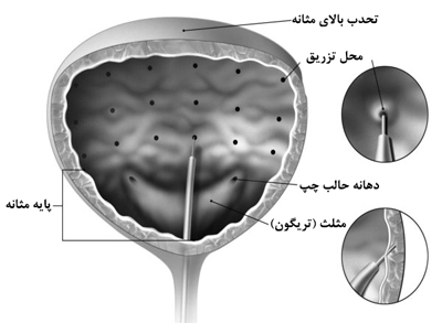 تزریق بوتاکس در مثانه