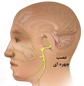 علت-ایجاد-فلج-بل-چیست