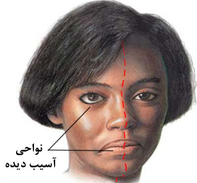 فلج-بل-چه-نشانه-هایی-دارد؟