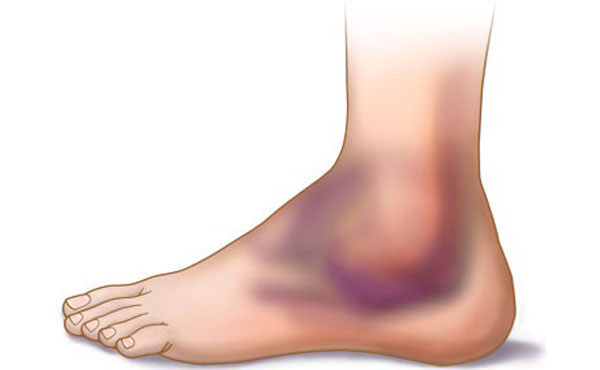 پیچ خوردگی مچ پا