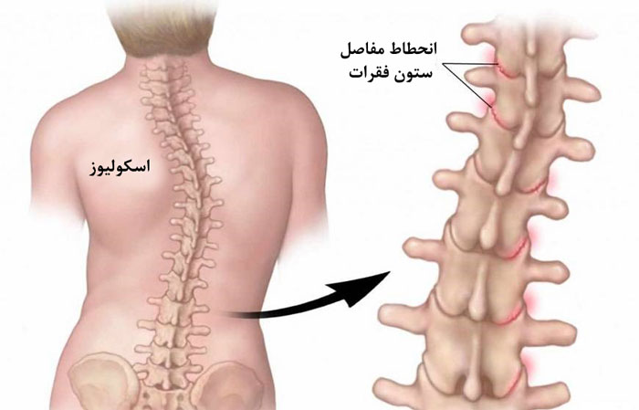 درمان کجی ستون فقرات (اسکولیوز) و اصلاح انحراف کمر به چپ و راست
