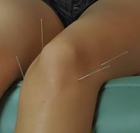 طب-سوزنی