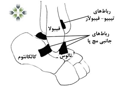 رباط های مچ پا چگونه دچار پارگی یا کشیدگی میشوند