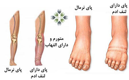 علل اولیه لنف ادم