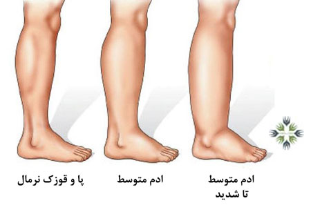 عوارض لنف ادم چیست