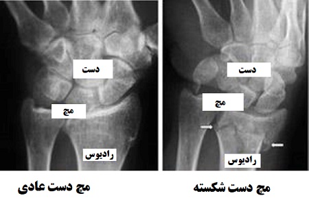 تشخیص شکستگی مچ دست