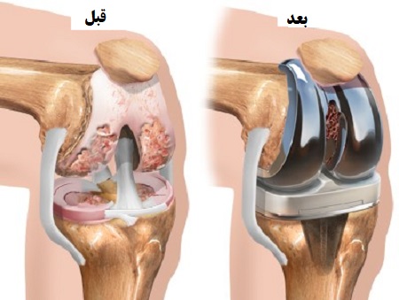 تعویض کل مفصل زانو