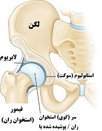 دررفتگی لگن تعویض شده