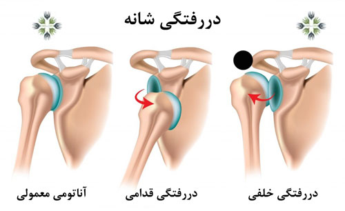 دررفتگی شانه چیست