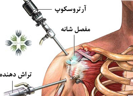 عمل جراحی شانه