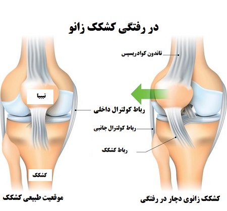 در رفتگی کشکک زانو چیست؟