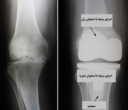 فرایند انجام جراحی تعویض مفصل زانو
