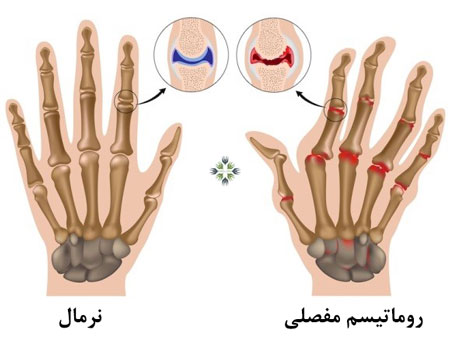 علائم روماتیسم مفصلی چیست