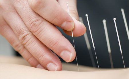طب سوزنی چیست و چگونه کار می‌کند؟