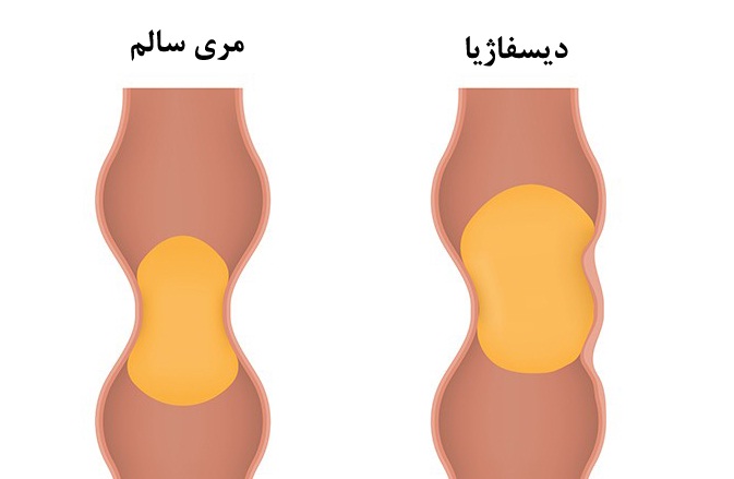 درمان اختلال بلع و مشکلات غذا خوردن در کودکان و بزرگسالان (دیسفاژیا)