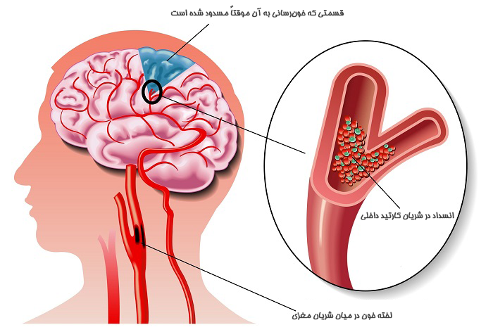 سکته مغزی چیست و چرا اتفاق می‌افتد؟