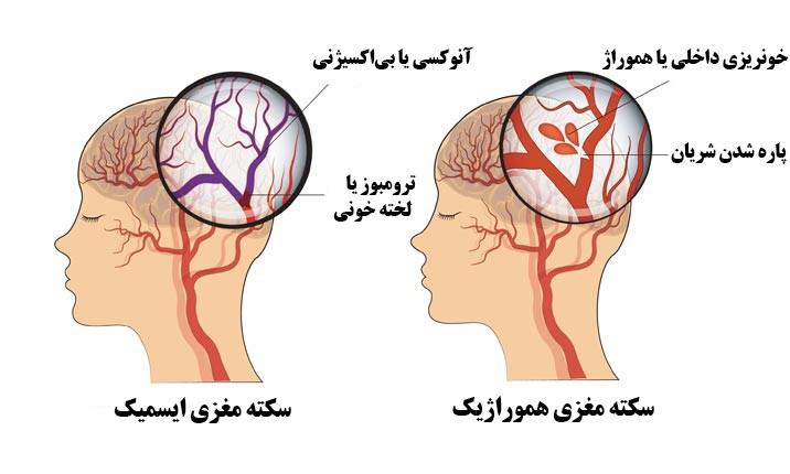 سکته چیست؟