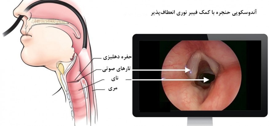 آندوسکوپی حنجره با کمک فیبر نوری انعطاف‌پذیر