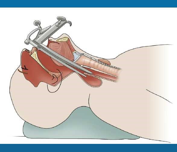 آندوسکوپی غیر منعطف حنجره از طریق دهان