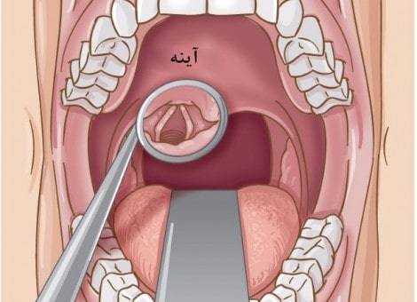 آینه لارنگوسکوپی