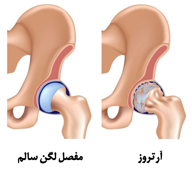 آرتروز لگن