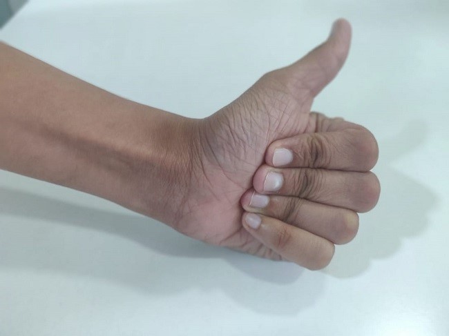 آرتروز مچ دست