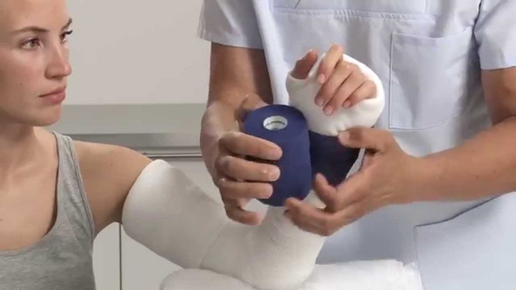 گچ گیری شکستگی آرنج دست