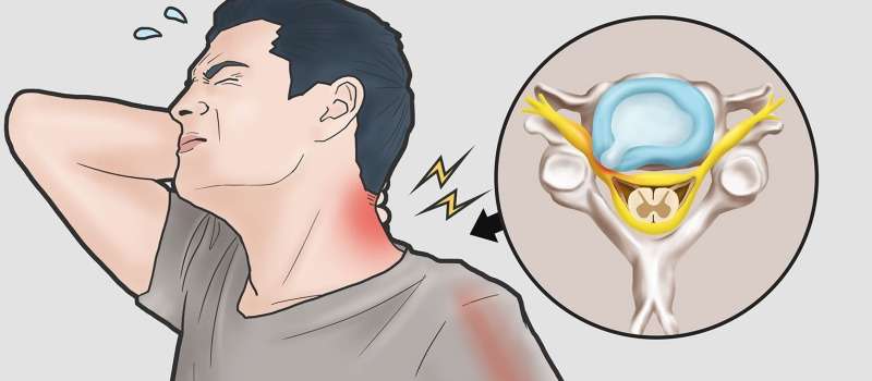 علائم دیسک گردن