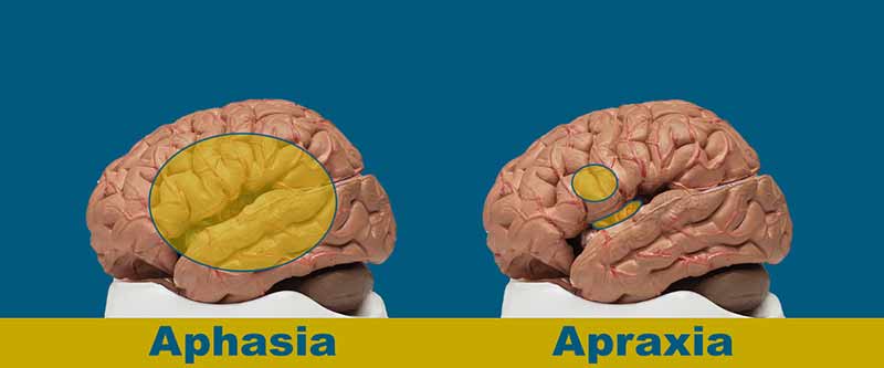 تفاوت بین آپراکسی گفتاری و آفازی چیست؟