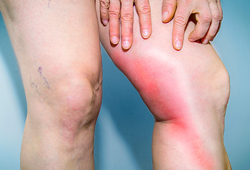 dvt ترومبوز ورید عمقی بر اثر زیاد نشستن