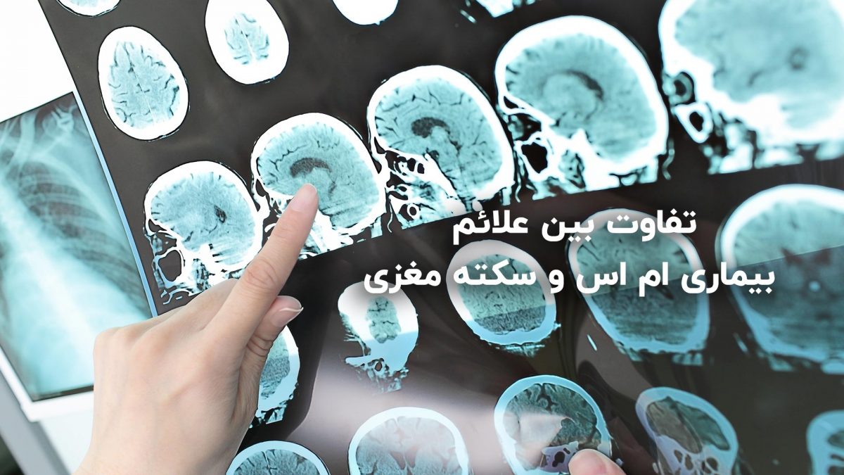 تفاوت بین ام اس و سکته مغزی