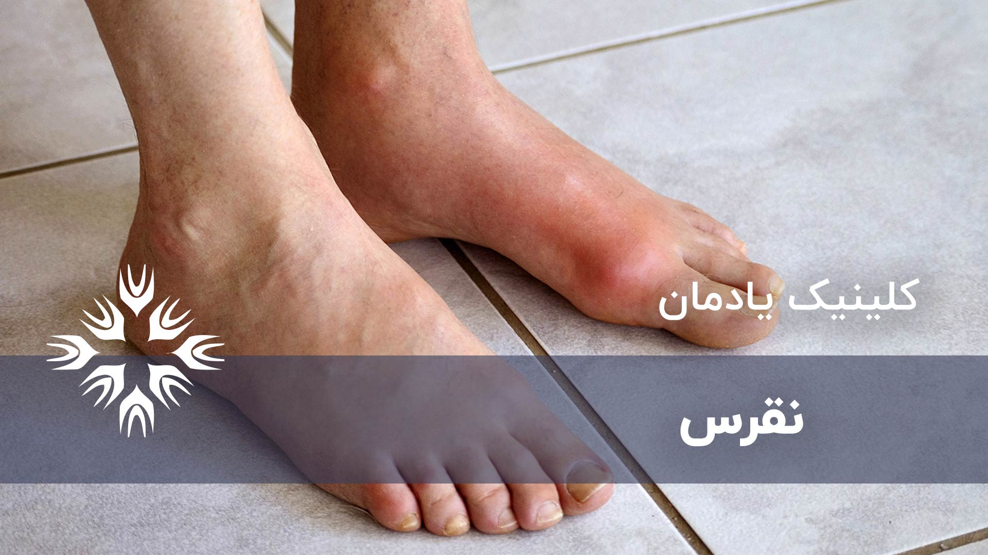 نقرس