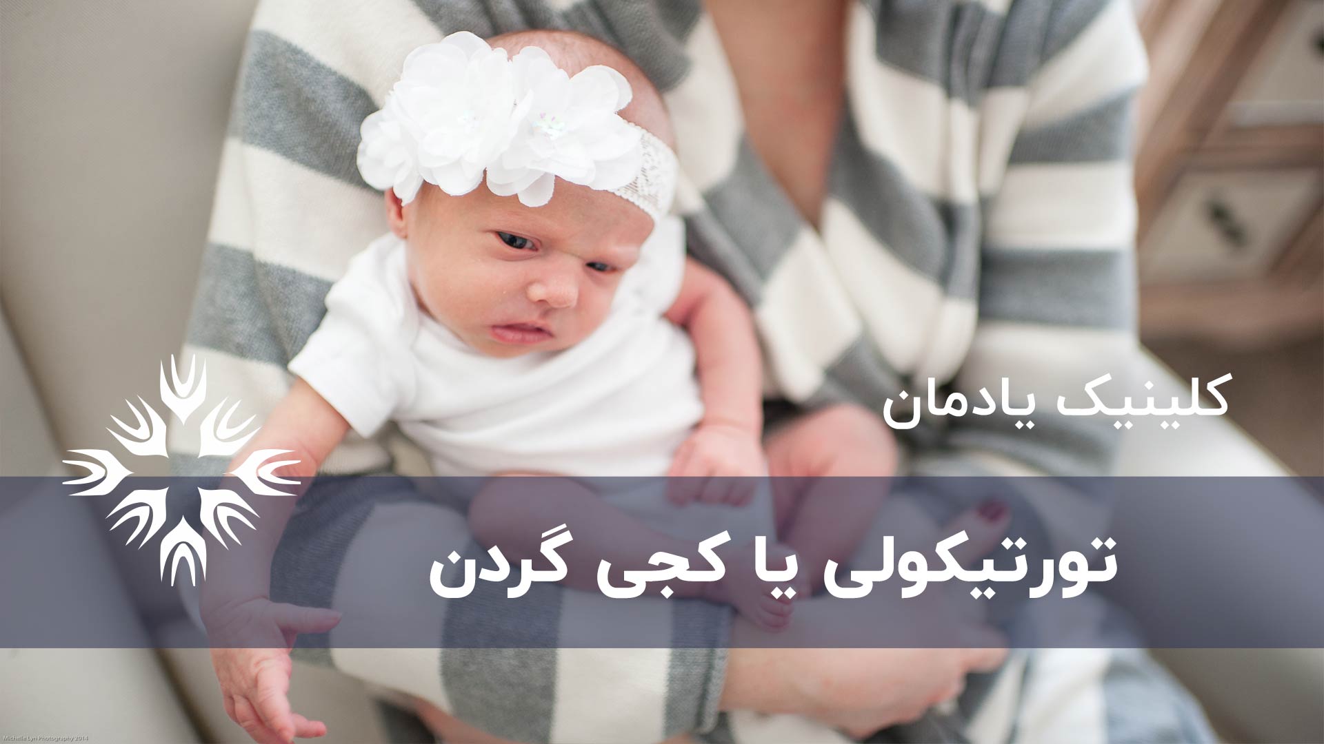 تورتیکولی یا کجی گردن در نوزاد