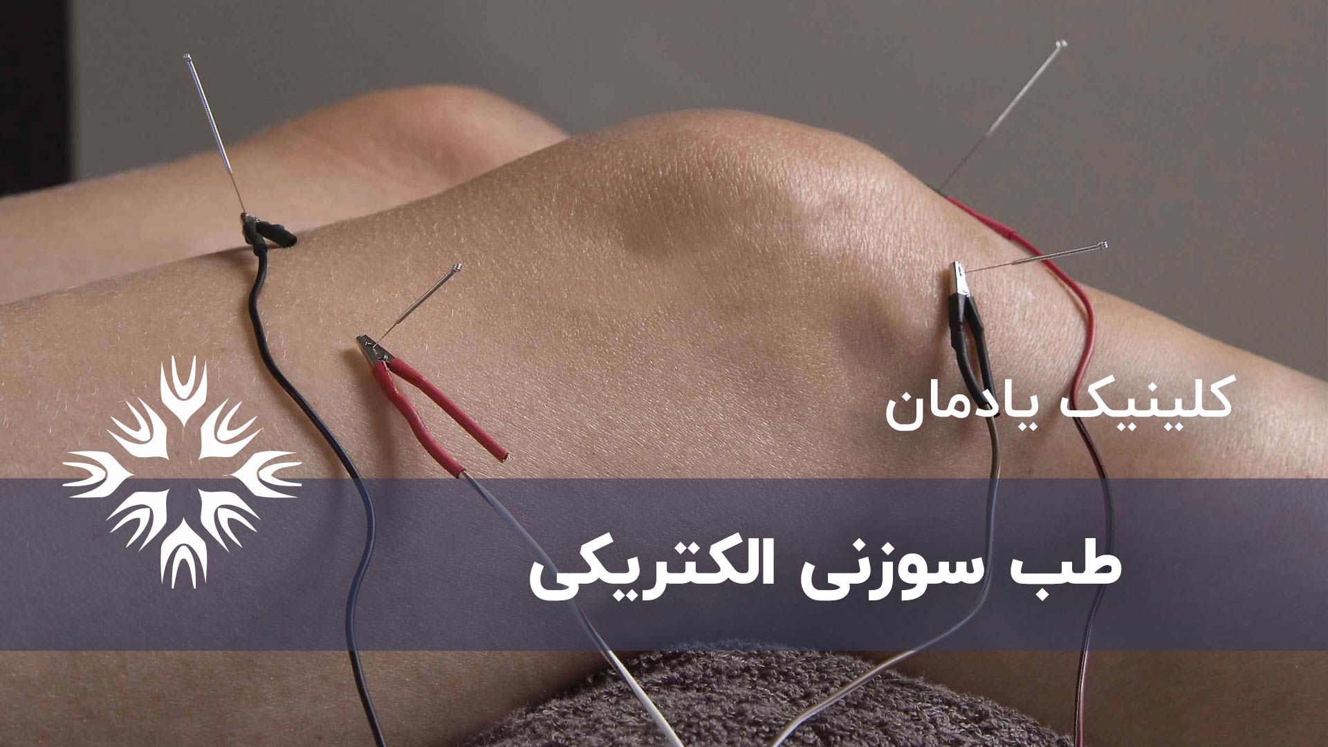 طب سوزنی الکتریکی یا الکترواکوپانکچر