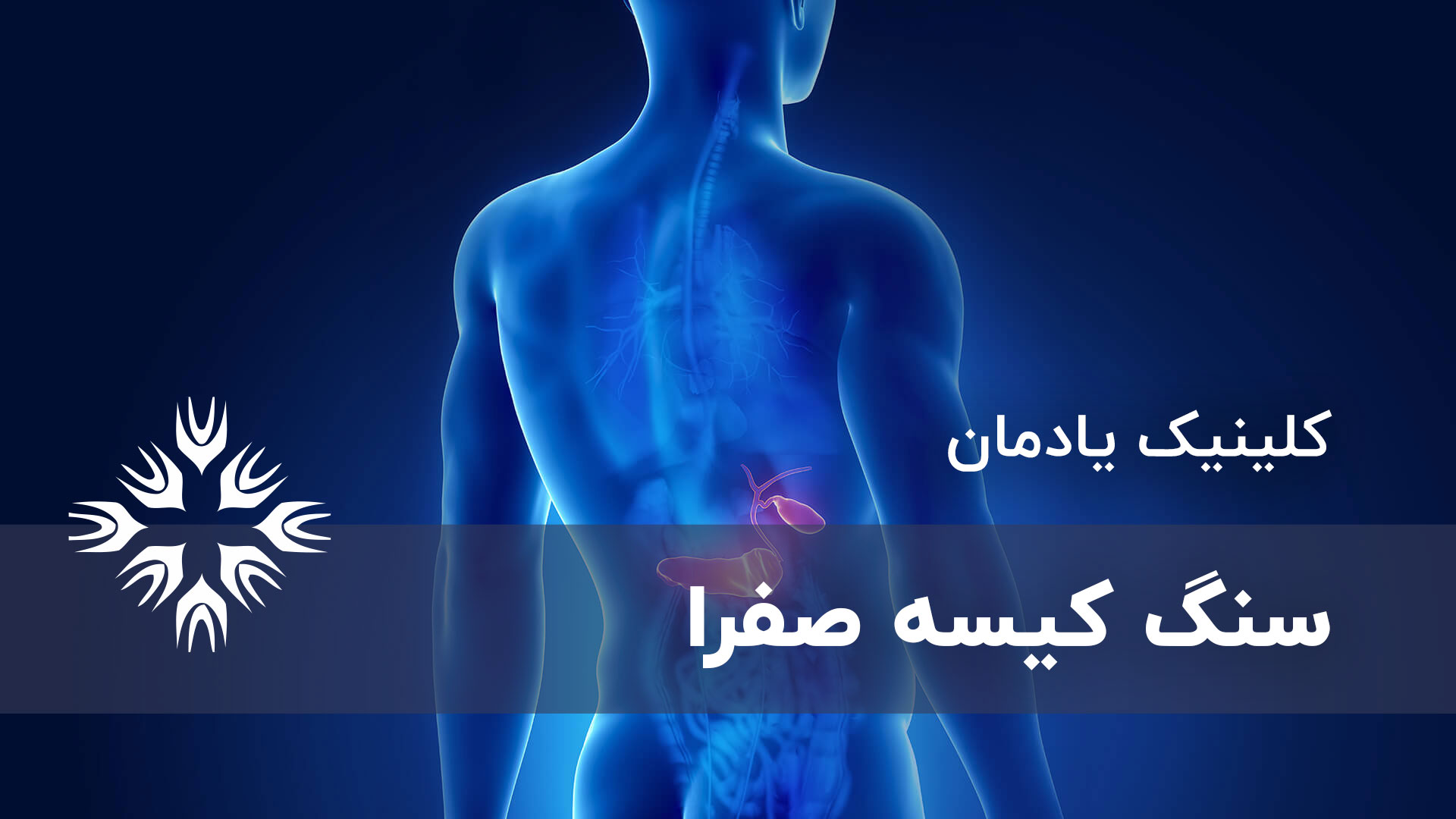 سنگ کیسه صفرا