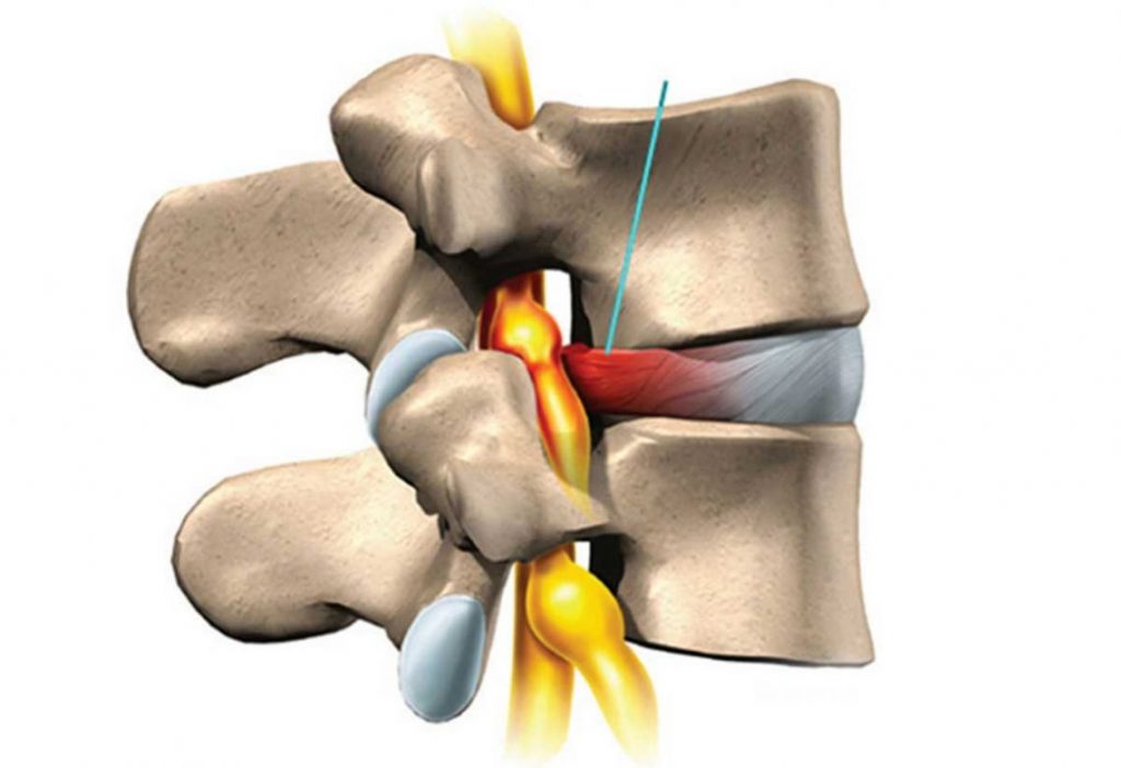 علائم دیسک کمر